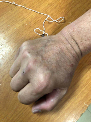 公路检疫站值班人员除下手套，手部皮肤干裂.jpg